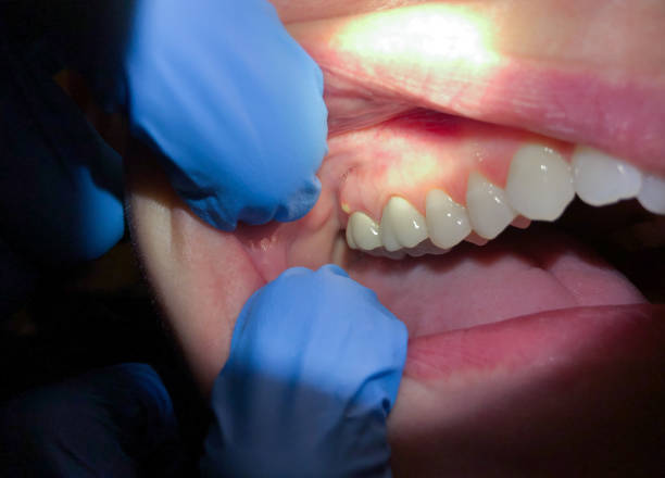 Best Emergency Broken Tooth Repair in Denham Springs, LA